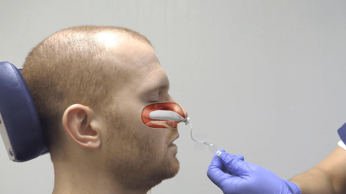 鼻部手術止血棉的選擇 林漢琛醫師耳鼻喉頭頸外科