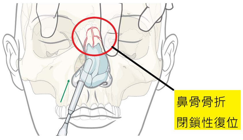 鼻骨骨折怎麼辦 林漢琛醫師耳鼻喉頭頸外科