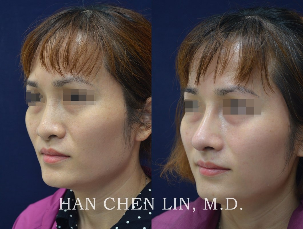 自肋結構式鼻整形 – 美麗的鼻形，更好的呼吸